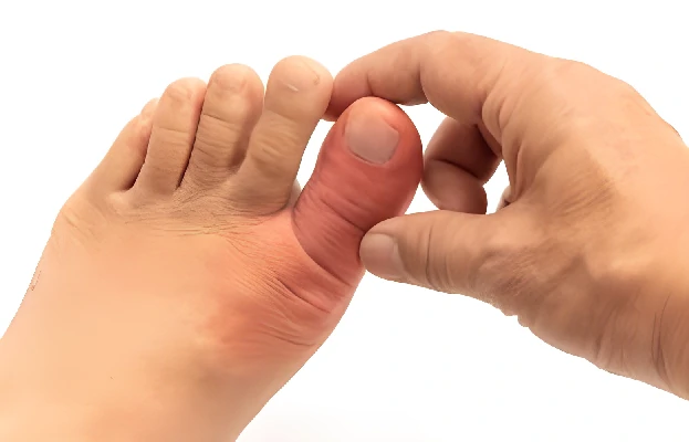 Tips Mengatasi Asam Urat : Umur 40+ Wajib Baca Tips Mengatasi Asam Urat : Umur 40+ Wajib Baca